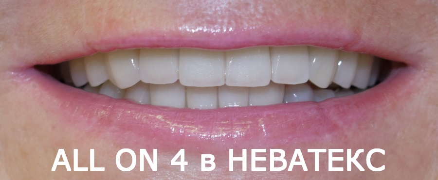 Фото после протезирования на 4 имплантах протезирование зубов на 4 имплантах стоимость фото до и после